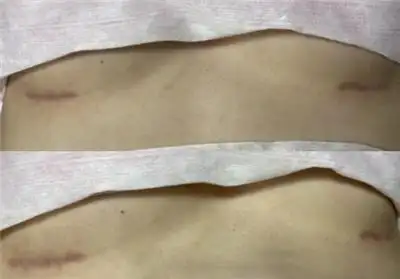 假体隆胸手术下皱襞切口明显