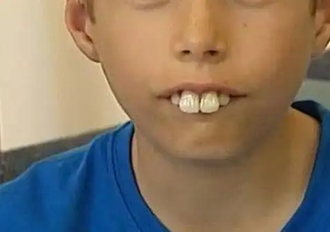 龅牙图片和症状图片矫正突出牙齿的其它方法可能包括使用牙齿矫正器.