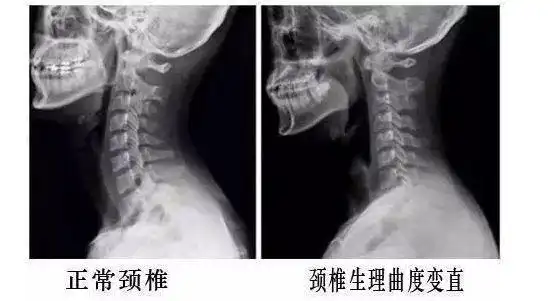 颈椎c形生理曲度的存在,能增强颈椎的弹性,减轻和缓冲重力的震荡,防止