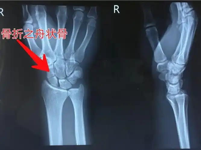 透视下herbert钉固定舟状骨骨折,关节镜下探查桡腕关节及腕中关节