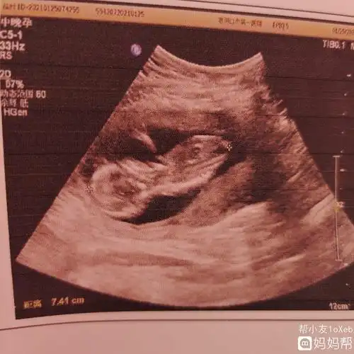 陪伴呵护!五个月男胎儿彩超图"五湖四海"-第2张图片-若克网