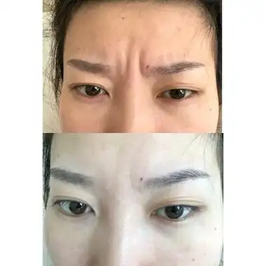 最近发现额头上的川字纹有点深,怎样去掉川字纹,玻尿酸填充的效果好吗