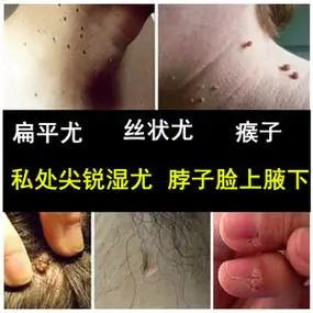 身上长小颗粒脖子腋肉下皮赘肉疙瘩小肉丁丁肉揪揪线瘊软纤维瘤