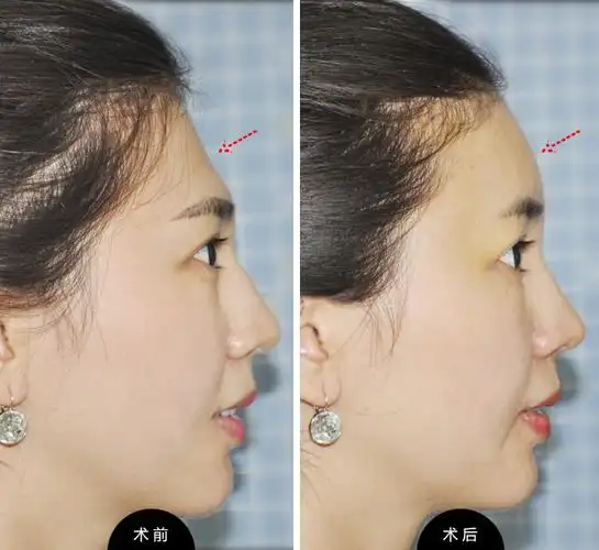 颜世楠,自体脂肪丰额头,对比图,长春好的整形医院