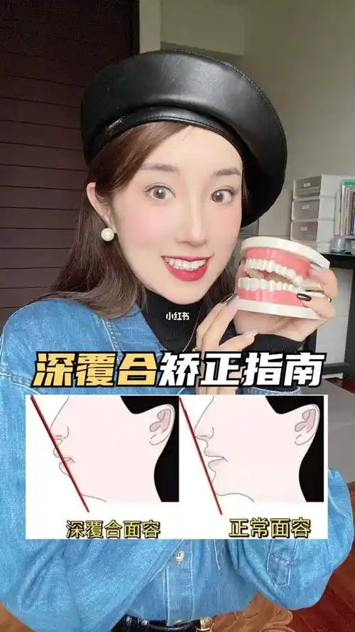 凸嘴必看如何判断自己是否深覆合