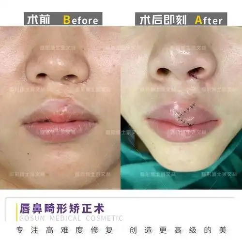 所以,隐形唇裂畸形不明显,就可以不治疗了吗?当然不是!