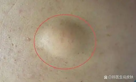 边界比较清晰,体积比较小,脂肪瘤(lipoma)是一种常见的软组织良性肿瘤