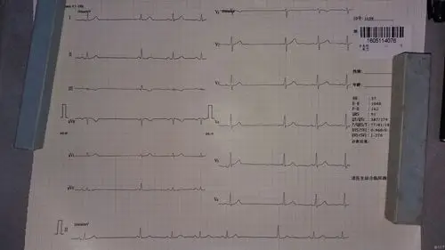 二度ii型窦房传导阻滞? - 心电图脑电图专业讨论版 - 爱爱医医学论坛