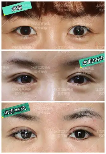 双眼皮修复#案例分析,眼睛如何修复更美丽.