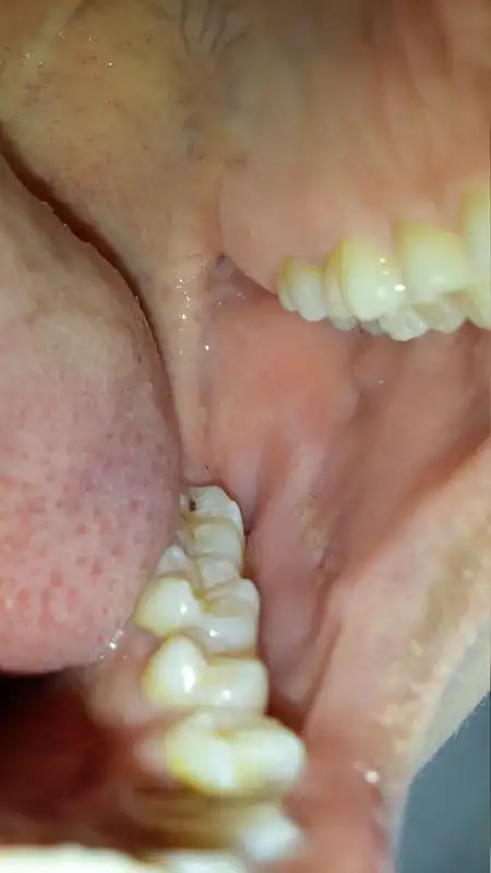 口腔内颊白线被我经常咬咬后突出白色肉