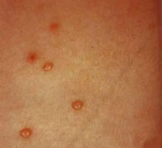 女性尖锐湿疣早期症状图片