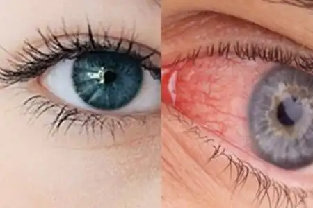 眼睛发炎怎么治疗呢如何护理眼部疾病