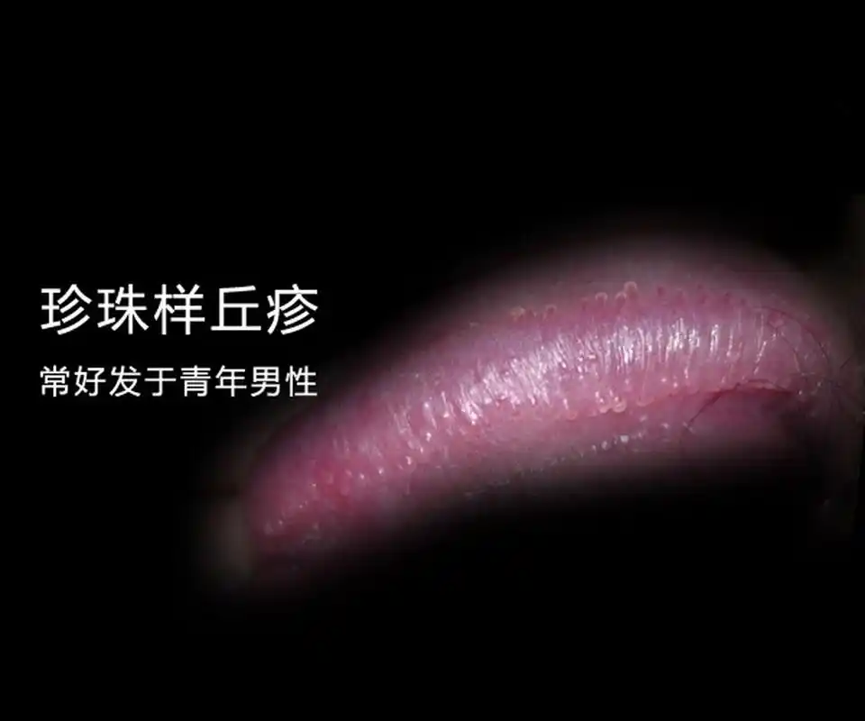 其多发生于男性的龟头冠状沟处,此病病因尚不明确,可能与局部刺激等