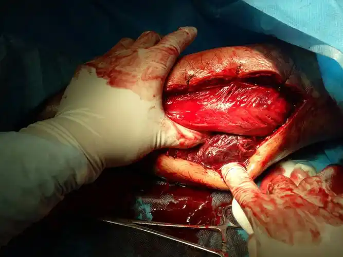 一例车祸导致胫骨平台骨折伴骨筋膜室综合征的单亲父亲的保肢历程.