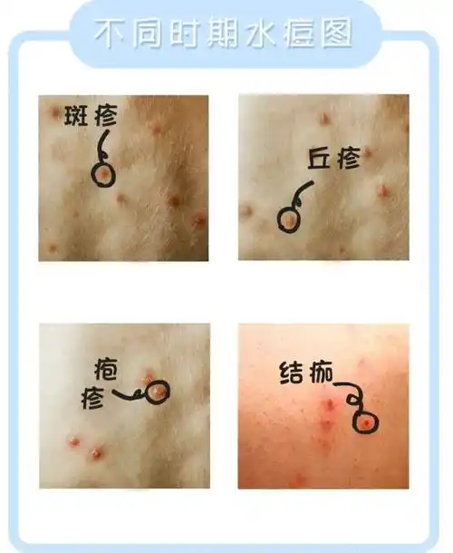 健康提示冬季水痘来袭家长们要给孩子做好这些基础防护