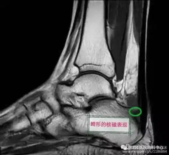 滑囊炎可以由损伤引起,部分是直接暴力损伤