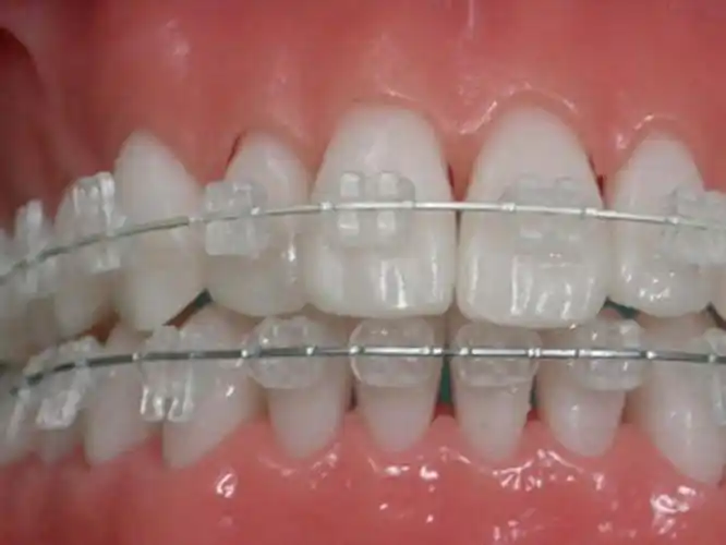 陶瓷透明托槽矫正矫正牙齿不再尴尬