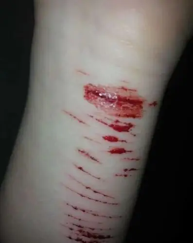 0 你好,很理解你的心情,麻木感,找不到存在的感觉,想通过自残