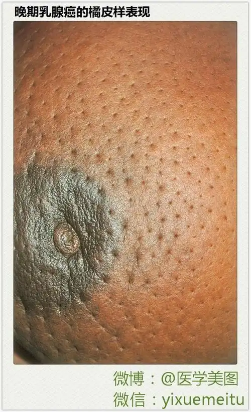 [猎奇图片 ] 晚期乳腺癌的橘皮样表现