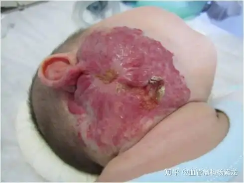 婴儿血管瘤严重吗哪些需要积极治疗该如何治疗