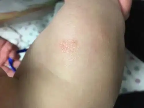 儿童常见皮肤病有哪些儿童各种常见皮肤病症状对照图2