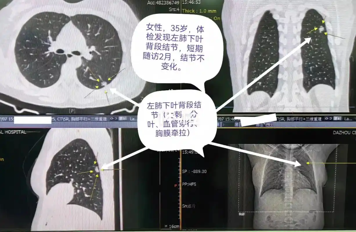 肺小结节的薄层ct检查.对于肺小结节,治疗指南都是建议行胸部 - 抖音