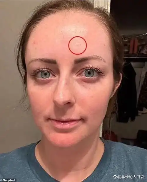 从小痘痘到癌症,美国妹子的皮肤癌经历令人痛心!