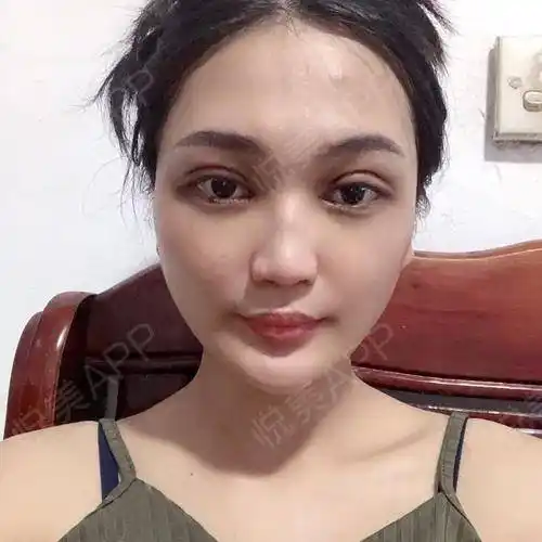 眼睛恢复得很好,已经消肿了很多,今天去医院.眼综合整形_悦美整形