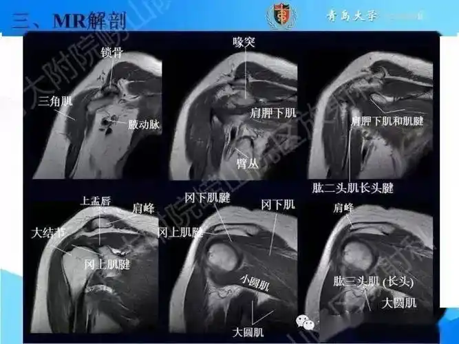 1肩袖解剖肩袖(rotator cuff)损伤由smith于1834年发现并命名,指组成