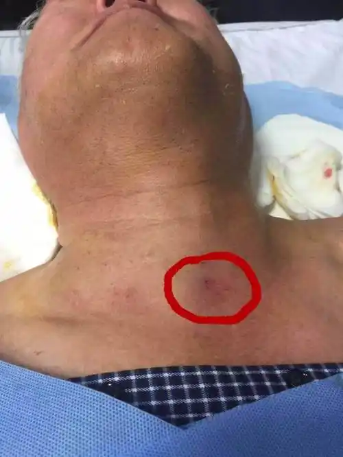 【临床一线】3分钟,和甲状腺巨大结节说再见!