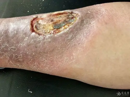 2016年皮肤版有奖病例猜答10答案坏疽性脓皮病