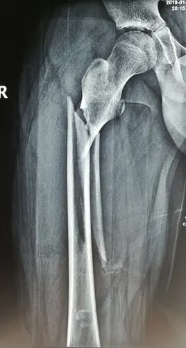 我科完成深圳市首例青少年股骨粗隆下骨折髓内钉内固定术