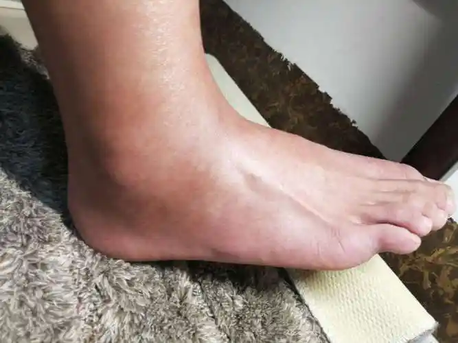 这是一个典型的踝部扭伤导致距腓前韧带损伤病历损伤