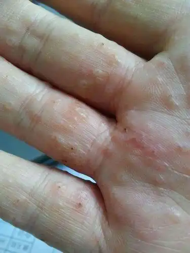 手上亮晶晶的小水疱又痒又痛反复发作其实是汗疱疹在作怪医生建议这样
