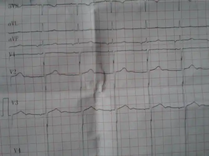 逆行的p波 - 心电图脑电图专业讨论版 - 爱爱医医学论坛
