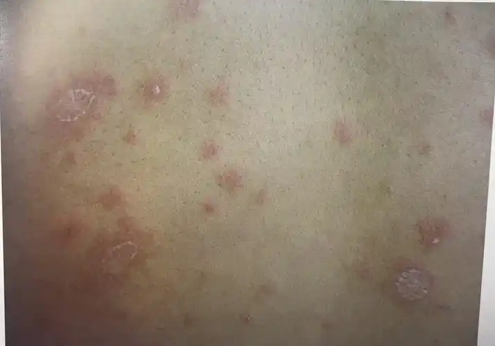 玫瑰糠疹症状_病因_治疗方法_鉴别_专家咨询|丁香医生