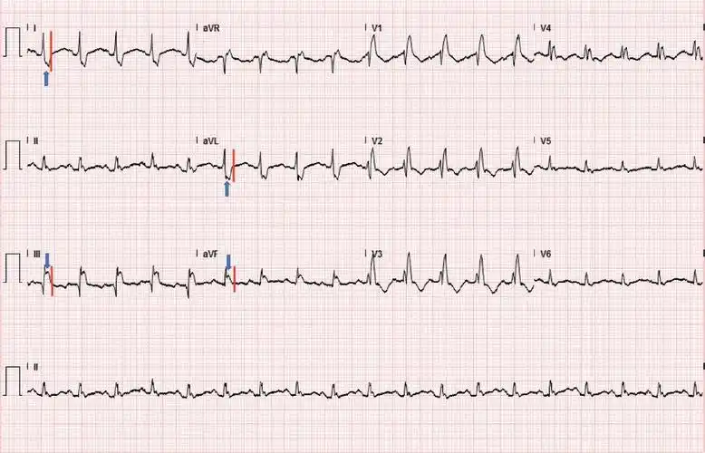 心电图诊断上,可以看到w-p-w综合征的字眼一样,完全性右束支传导阻滞
