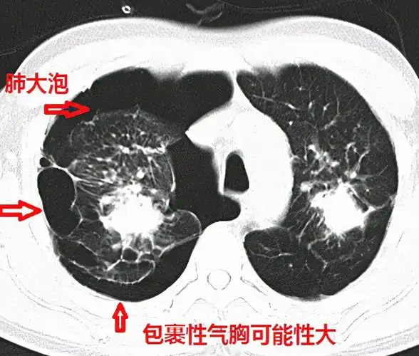 肺大泡能跑步吗肺大泡患者需注意的几点