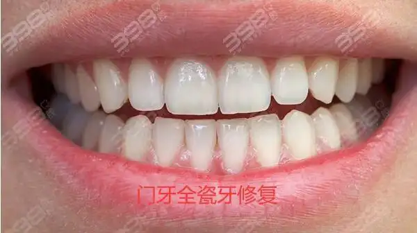 门牙用烤瓷牙好还是全瓷牙好?