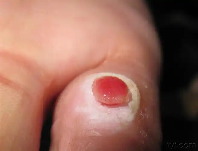 看图识病化脓性肉芽肿