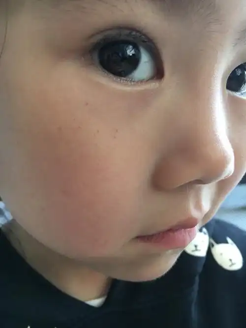 女儿4周岁 脸上怎么有小斑