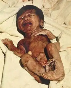 胎儿宫内缺氧时,肠系膜血管收缩,局部缺血增加肠蠕动,肛门排便污染