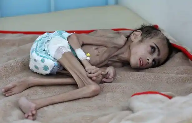 被遗忘的也门战争:7岁男孩遭饥饿蹂躏,体重不到14斤