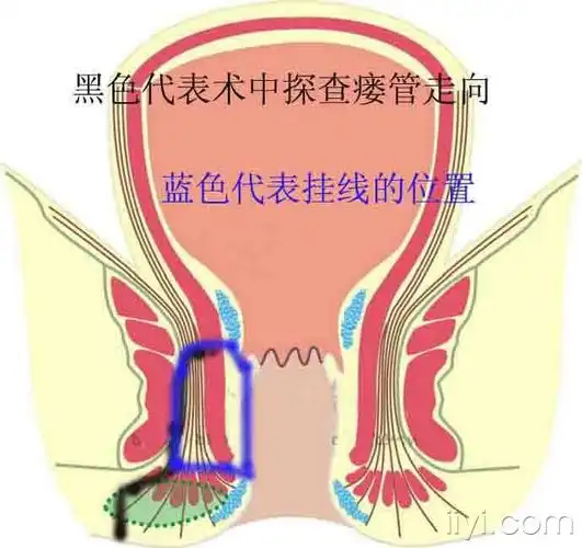 今天做的一例肛瘘
