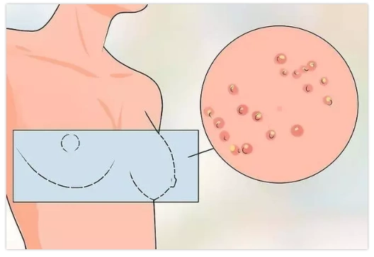 【健康大讲堂】_乳腺癌_症状表现_检查 - 好大夫在线