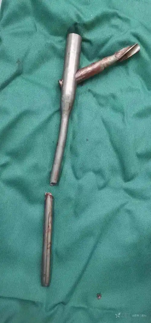 股骨近端髓内钉断裂取出方法介绍