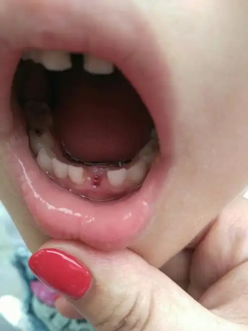 乳牙没掉,新牙直接长牙龈里边了,怎么办?