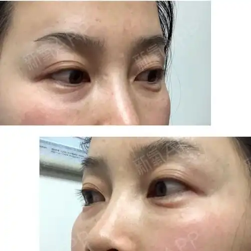 填充雅致第二天～～泪沟的地方出现了一点点肿胀,可以_圈子-新氧美容