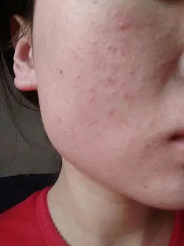 我今年18岁,这几天脸上起了密密麻麻的红疹子,用护肤品的话,脸会有点