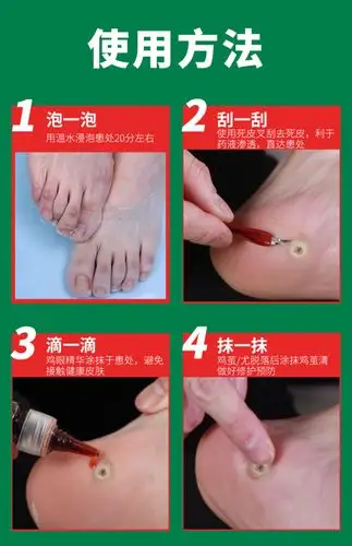 云南本草鸡眼膏去手足部脚底瘊子老茧肉刺根脚趾疣去疣灵鸡眼贴_帮您